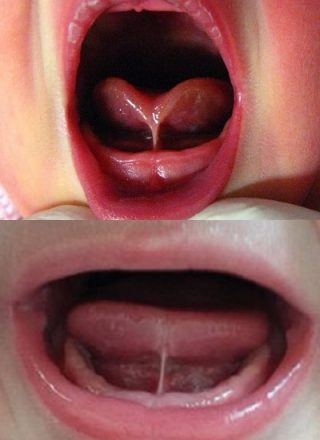 Image to illustrate what a tongue tie looks like